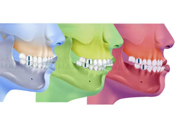 Class II & Class III Malocclusion Correction