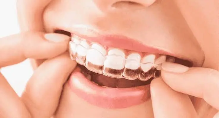 Clear Aligners Invisible Braces