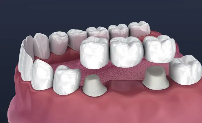 Dental Crowns & Bridges