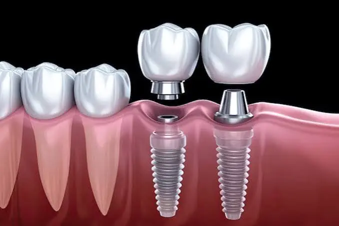 Dental Implants & Tooth Replacement