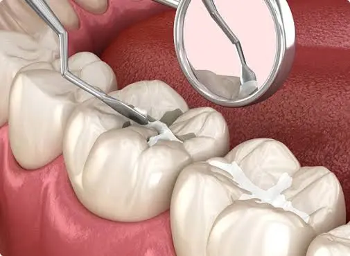 Fluoride Treatment & Dental Sealants