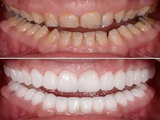 Full-Mouth Rehabilitations