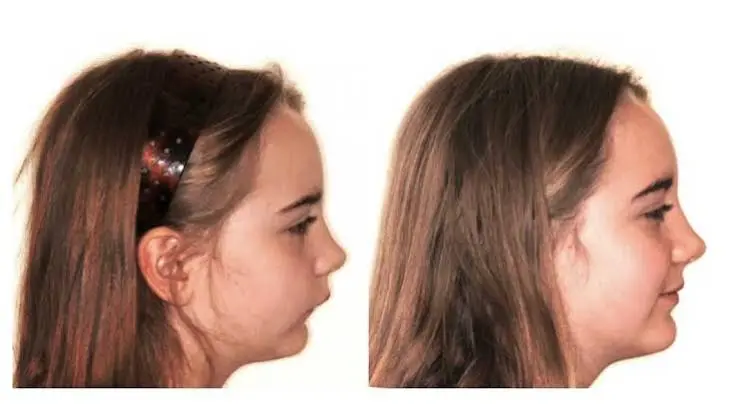 Growth Modification
