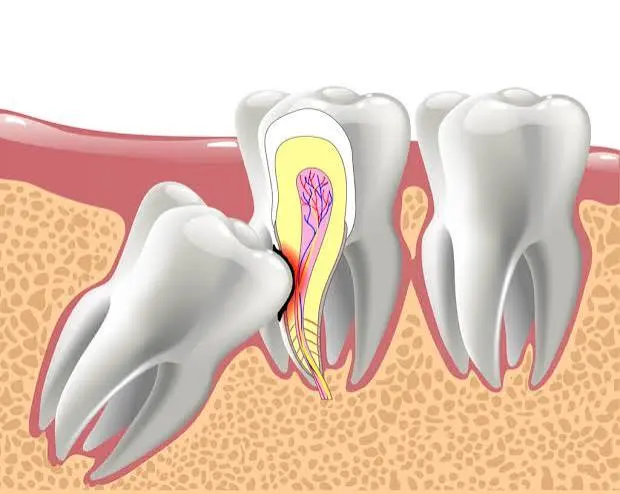 Impacted Tooth Management