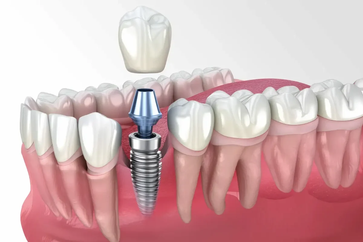 Implant-Supported Crowns