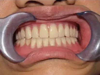 Maxillary & Mandibular Dentures