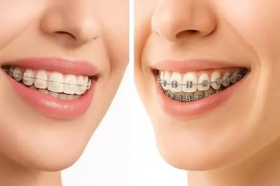 Metal & Ceramic Braces