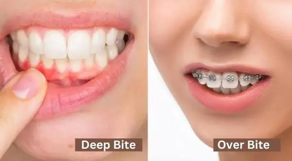 Overbite Deep Bite Correction
