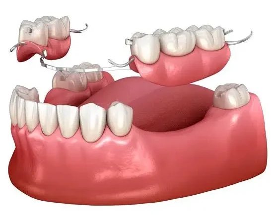 Partial Dentures