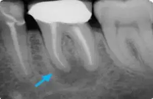 Re-Root Canal Treatment