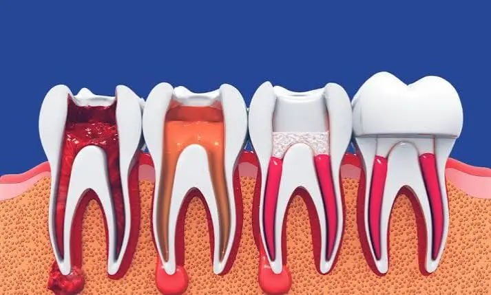 Single Sitting Root Canal Treatment