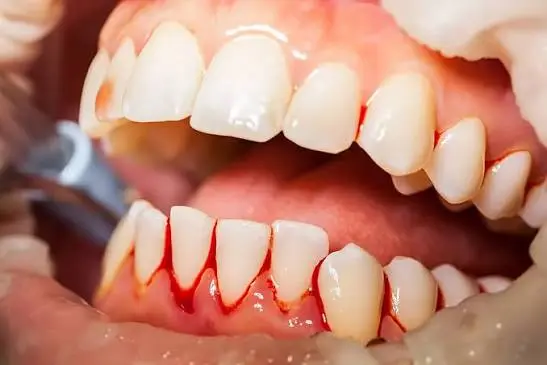 Bleeding Gum Treatment
