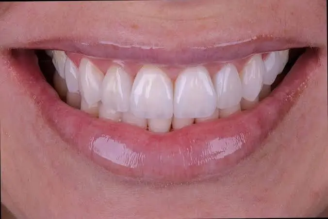 Composite Bonding & Aesthetic Restorations