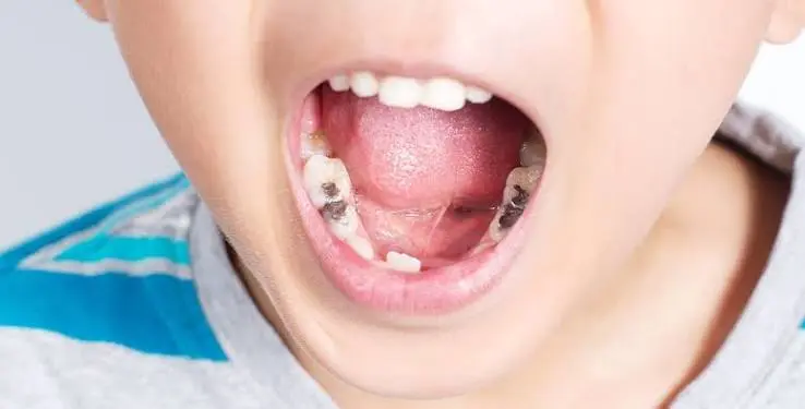Dental Fillings for Children