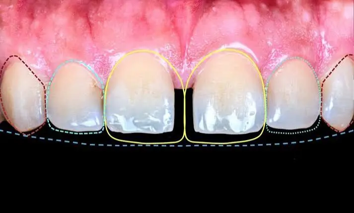 Diastema Closure