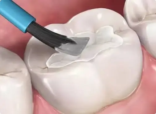 Fluoride & Sealant Treatment