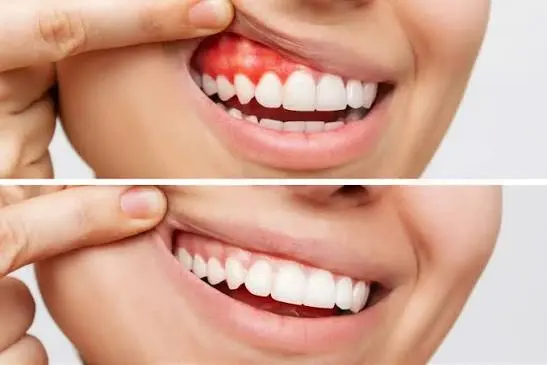Gum Disease Treatment