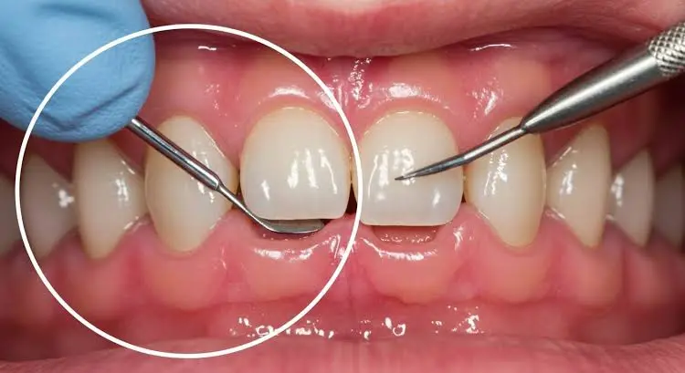 Gum Recession ManagementGum Recession Management