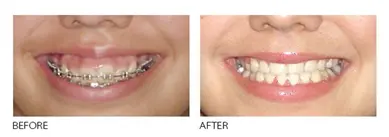 Gummy Smile Management