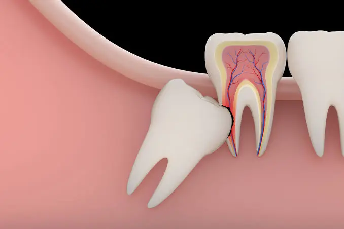Impacted Tooth Management
