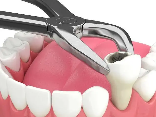 Oral Surgery & Tooth Extraction