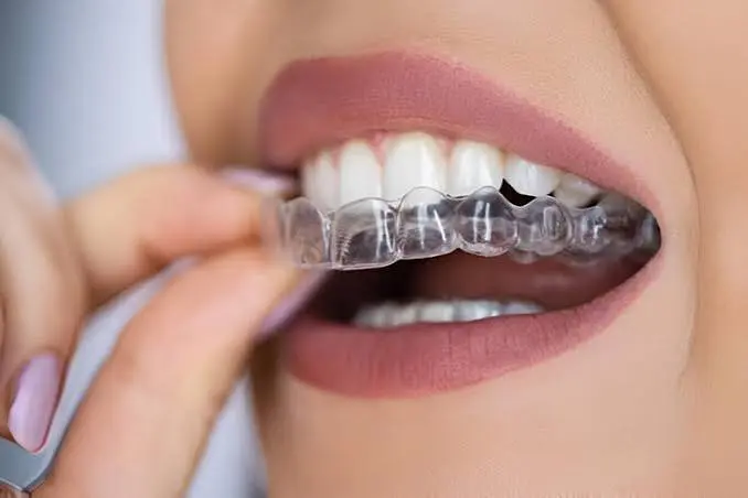 Orthodontic Retainers