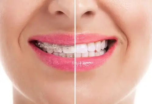 Relapse Management & Orthodontic Retreatment