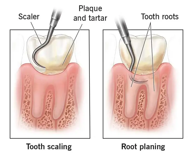 Scaling & Root Planing