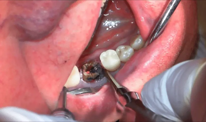 Surgical Tooth Extraction