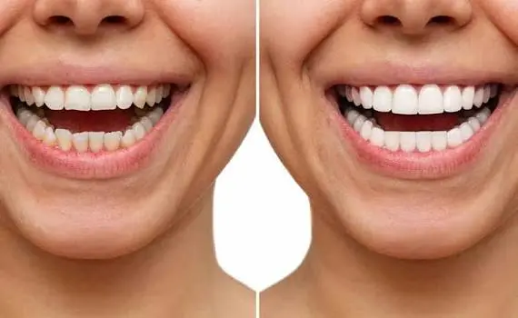Tooth Reshaping & Contouring