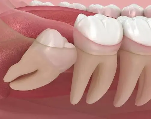 Wisdom Tooth Removal